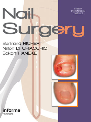 cover image of Nail Surgery